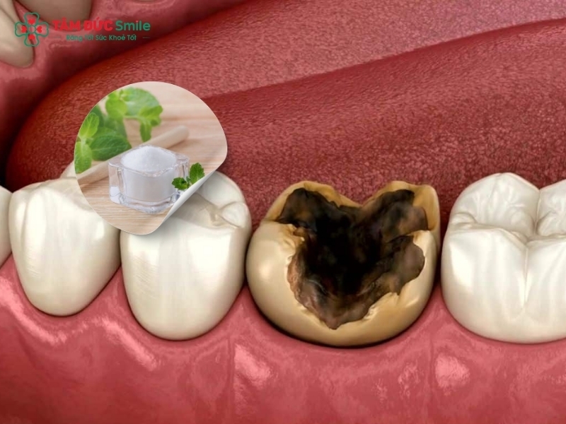 Cách trị sâu răng tại nhà phổ biến