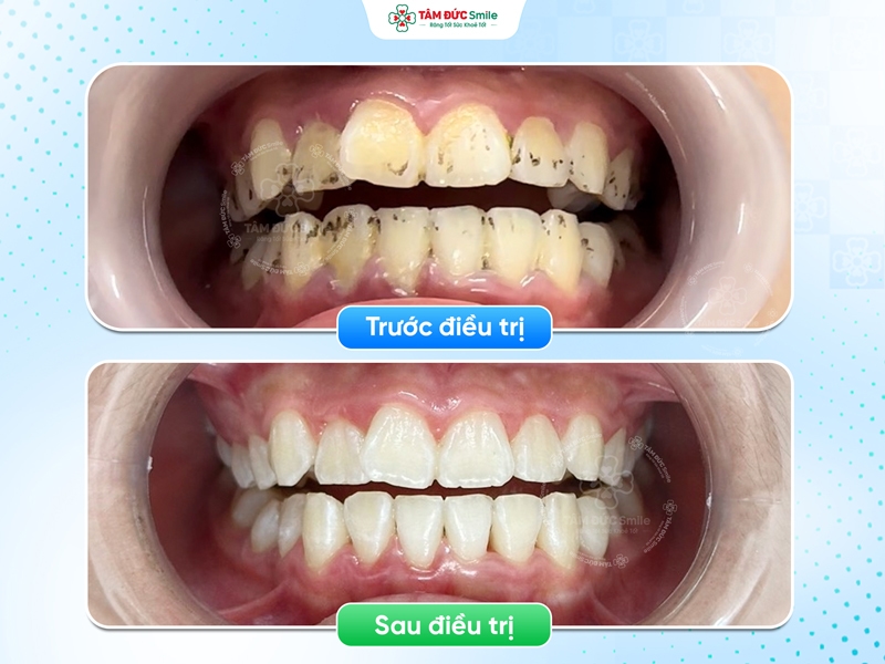 Cạo vôi giúp loại bỏ mảng bám cứng, làm sạch chân răng và hỗ trợ cải thiện sức khỏe nướu