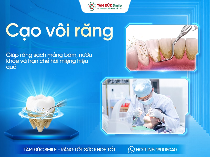 Cạo vôi răng là gì? Chi phí, Lợi ích, Quy trình và Địa chỉ uy tín
