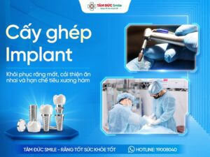 Cấy ghép Implant là gì? Quy trình, Chi phí và Lưu ý cần biết