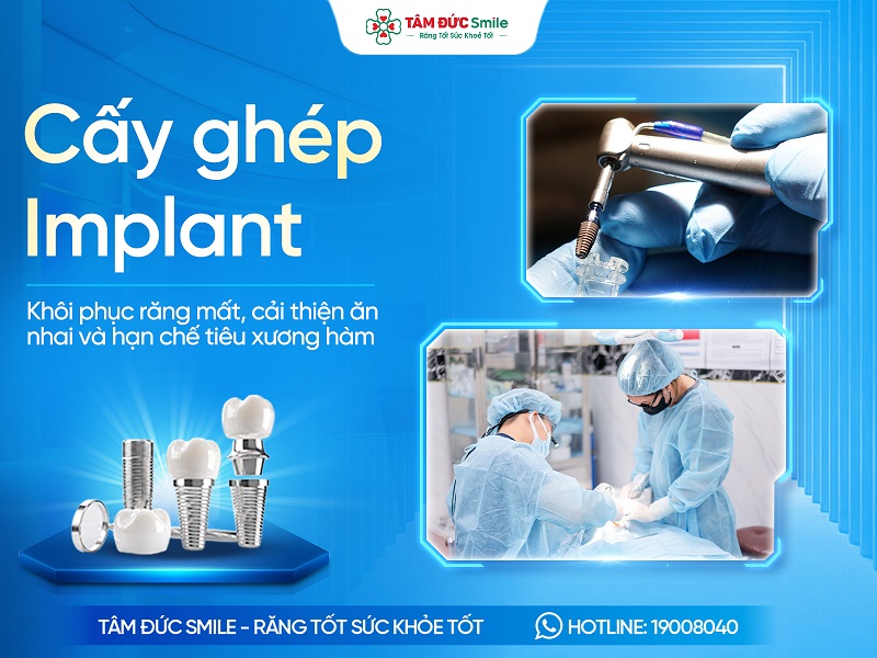 Cấy ghép Implant là gì? Quy trình, Chi phí và Lưu ý cần biết