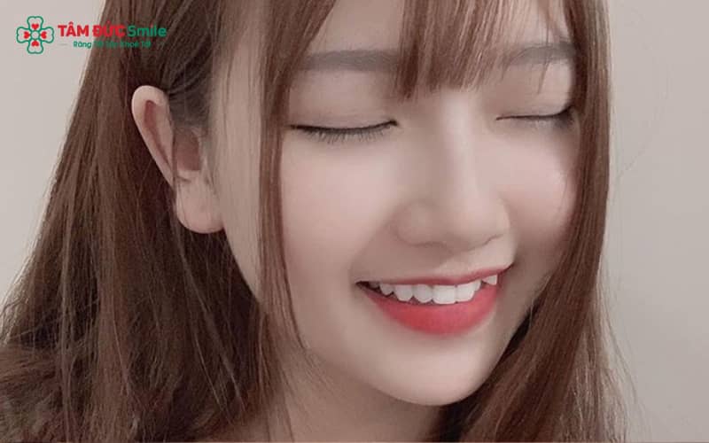 Hiện nay, chỉnh răng khểnh có thể thực hiện bằng nhiều phương pháp khác nhau, tùy vào mức độ lệch răng và nhu cầu thẩm mỹ của từng người