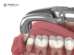 Có bầu nhổ răng khôn được không? Nên làm gì nếu mọc răng khôn khi mang thai?