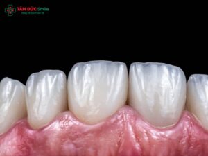 Danh sách địa chỉ dán răng sứ veneer uy tín TPHCM đẹp, an toàn, không đau