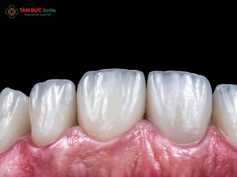 Danh sách địa chỉ dán răng sứ veneer uy tín TPHCM đẹp, an toàn, không đau