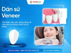 Dán sứ Veneer là gì? Quy trình, Chi phí và Địa chỉ uy tín