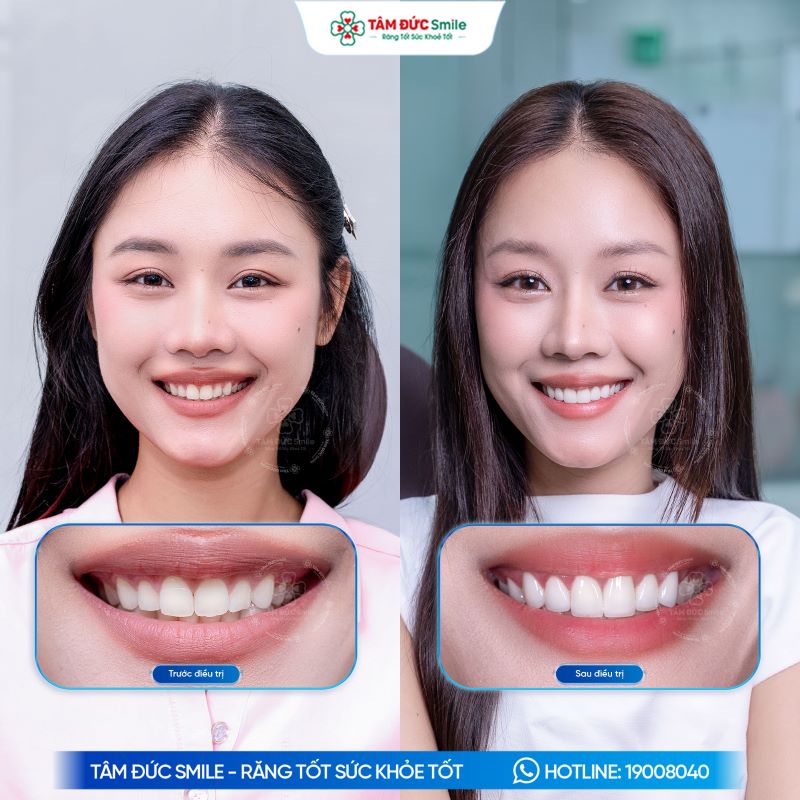 Khách hàng cải thiện màu sắc và hình thể nụ cười bằng Veneer, đồng thời hạn chế xâm lấn mô răng tại Nha khoa Tâm Đức Smile.