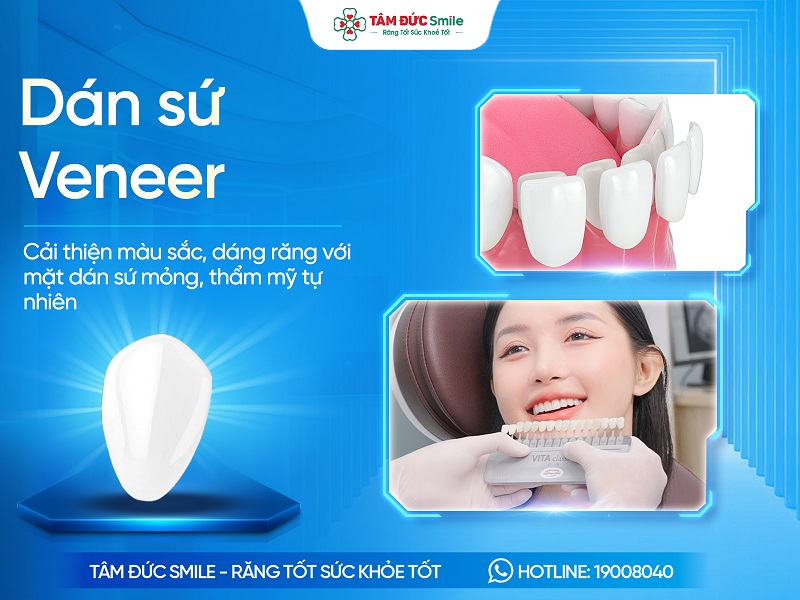 Dán sứ Veneer là gì? Quy trình, Chi phí và Địa chỉ uy tín