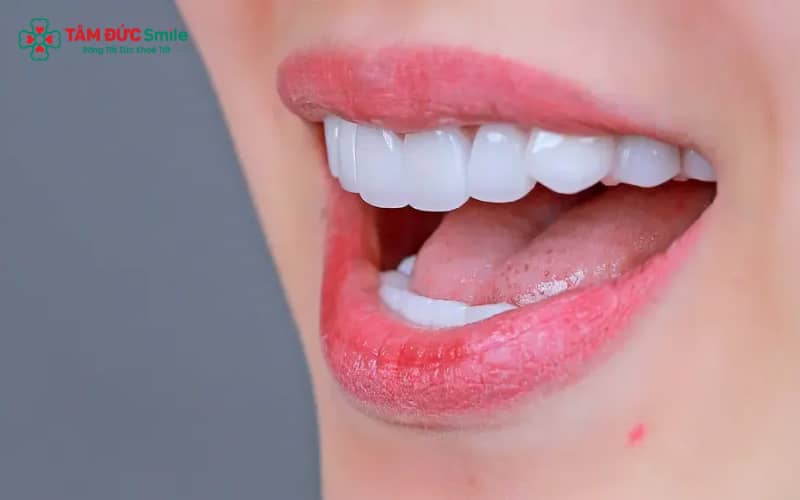 Đắp răng khểnh là phương pháp tạo hình răng nanh khểnh nhẹ nhằm tăng tính thẩm mỹ cho nụ cười.