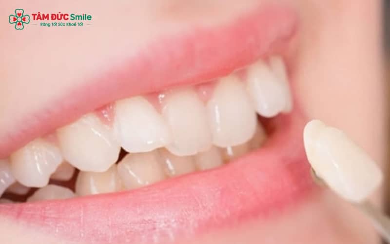 Hiện nay, đắp răng khểnh có thể thực hiện bằng nhiều phương pháp khác nhau, tùy tình trạng răng và nhu cầu thẩm mỹ