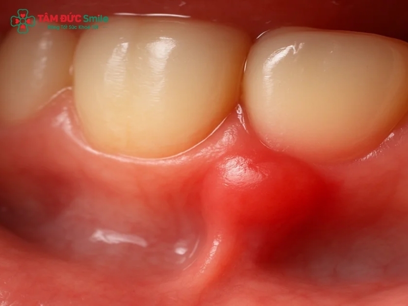 Đau nướu răng: Nguyên nhân, tác hại và cách điều trị hiệu quả