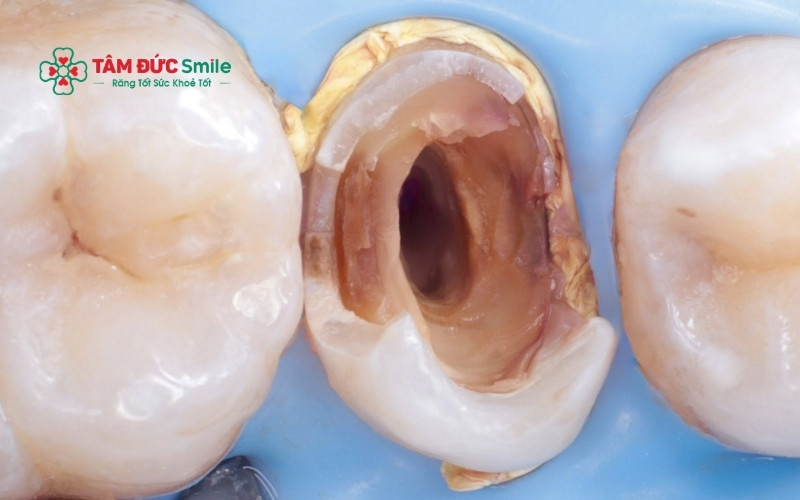 Nếu xuất hiện các cơn đau răng kéo dài lên đầu hoặc nướu bị sưng mủ, bà bầu cần đến nha khoa ngay lập tức để xử lý ổ viêm, tránh để vi khuẩn xâm nhập sâu vào cơ thể