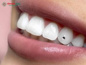 Đính đá răng khểnh thẩm mỹ: Có hại không, giá bao nhiêu, bền và đau không?
