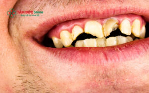 Gãy 2 răng cửa không chỉ làm mất đi nụ cười tự tin mà còn khiến việc cắn xé thức ăn trở nên khó khăn và ảnh hưởng trực tiếp đến khả năng phát âm rõ chữ