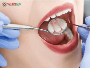 Hô hàm có niềng răng được không? Nguyên nhân hô xương hàm và cách niềng răng hô hiệu quả