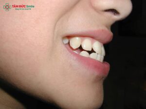 Hô hàm trên: Nguyên nhân, dấu hiệu, phương pháp chẩn đoán và điều trị hiệu quả