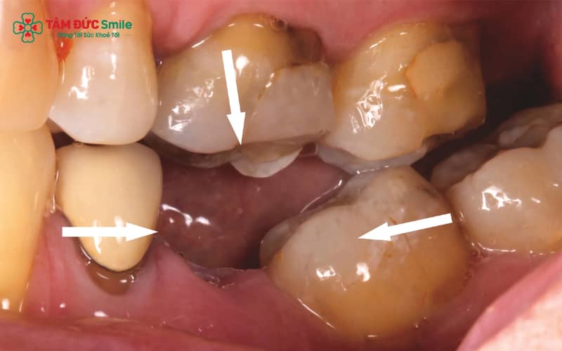 Chăm sóc đúng cách tại nhà, vệ sinh răng miệng nhẹ nhàng và tuân thủ hướng dẫn của bác sĩ giúp lỗ hổng sau nhổ răng khôn nhanh lành hơn