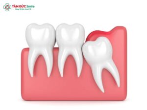 Lợi trùm răng khôn có tự hết không? Nguyên nhân, dấu hiệu và cách điều trị hiệu quả