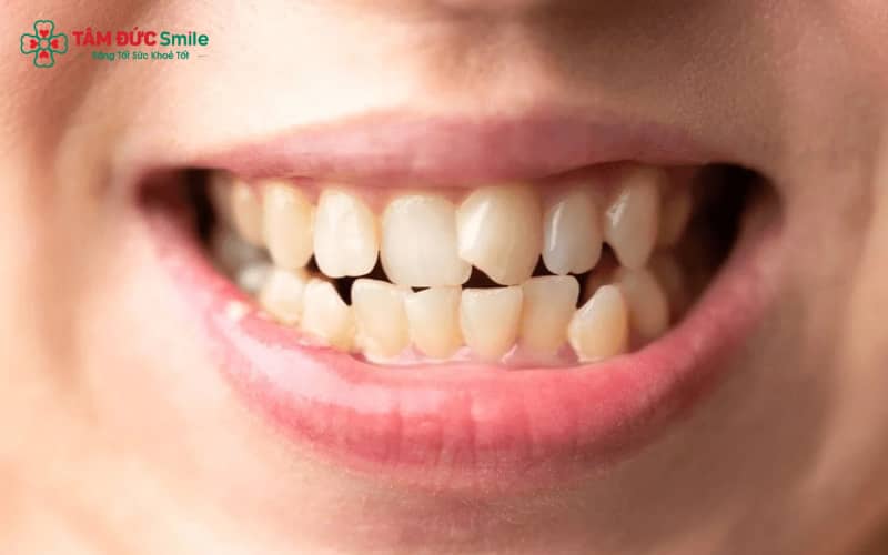 Theo quan niệm thẩm mỹ Á Đông, má lúm kết hợp răng khểnh giúp gương mặt trông trẻ trung, thân thiện và cuốn hút hơn
