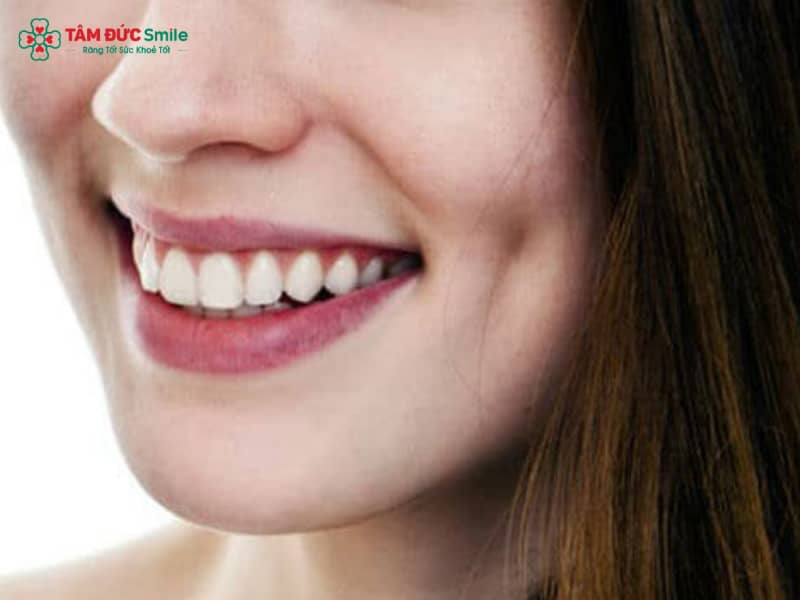 Má lúm răng khểnh có đẹp không? Ý nghĩa, thẩm mỹ răng khểnh duyên tự nhiên