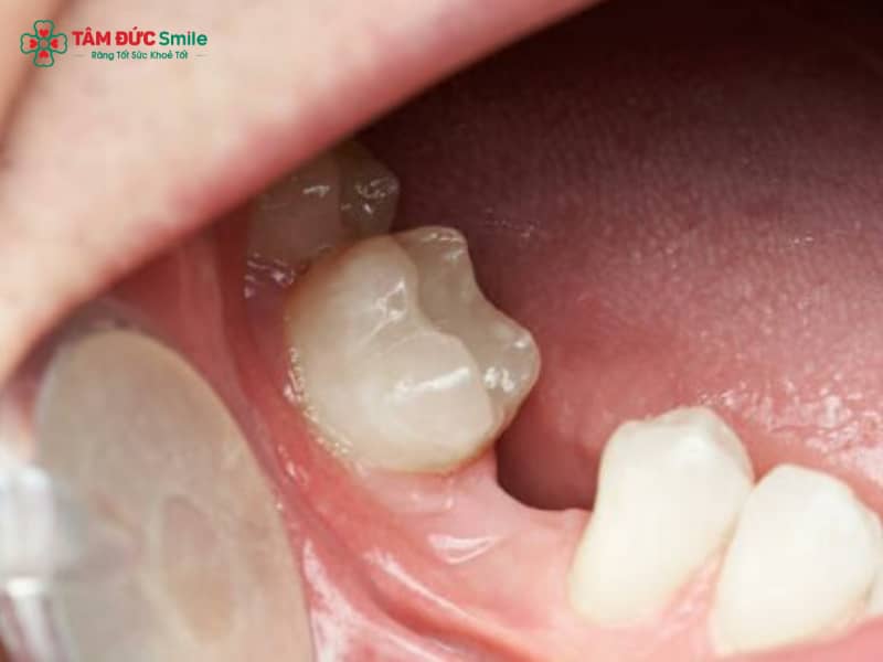 Mất răng số 5: Nguyên nhân, hậu quả, trồng răng số 5, cầu răng sứ, implant chuẩn