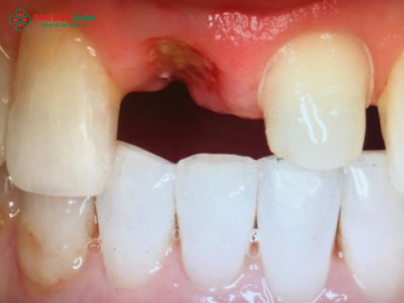 Mất răng số 7 hàm trên lâu năm, tiêu xương hàm, giãn xoang và giải pháp implant an toàn