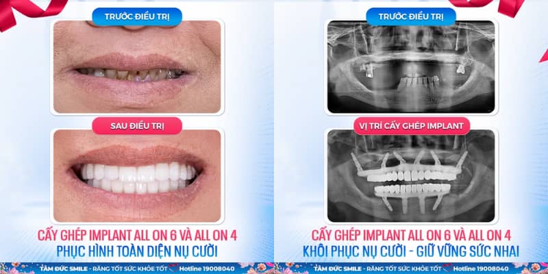 Hiệu quả trồng răng Implant: phục hồi răng như thật, ngăn tiêu xương, ăn nhai mạnh, bền chắc 20–30 năm