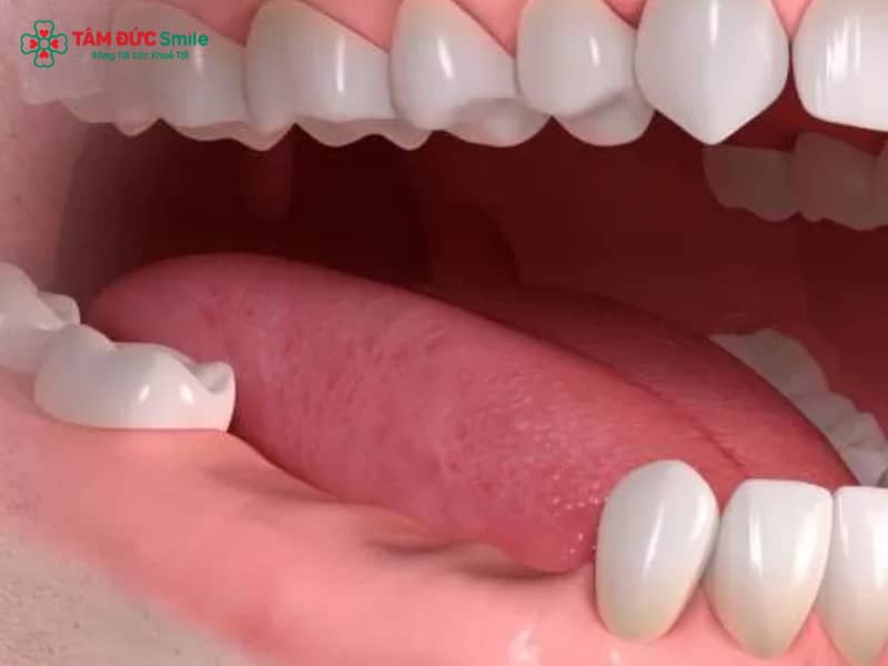 Mất răng vĩnh viễn: tiêu xương hàm, lệch khớp cắn và giải pháp phục hình hiệu quả