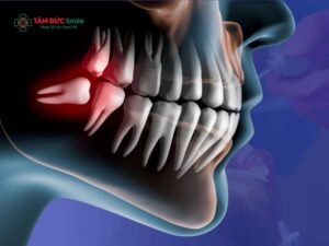 Vì sao mọc răng khôn nuốt nước bọt đau? Mọc răng khôn nuốt nước bọt đau phải làm gì?