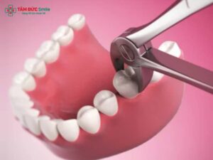 Nhổ răng cấm không trồng lại có sao không? Phương pháp trồng răng sau khi nhổ răng cấm