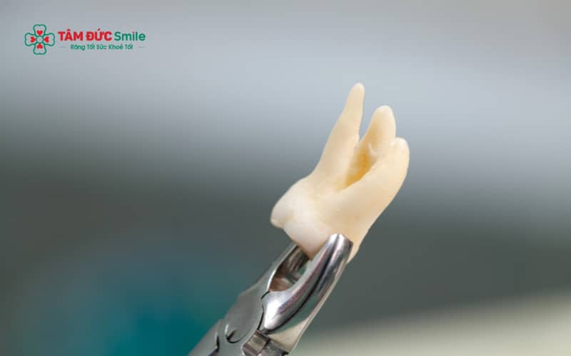 Khả năng súc miệng nước muối sau nhổ răng khôn thay đổi theo từng giai đoạn hồi phục của vết thươn