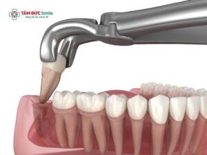 Nhổ răng khôn bao lâu thì súc miệng nước muối? Cách súc miệng nước muối đúng sau nhổ răng khôn