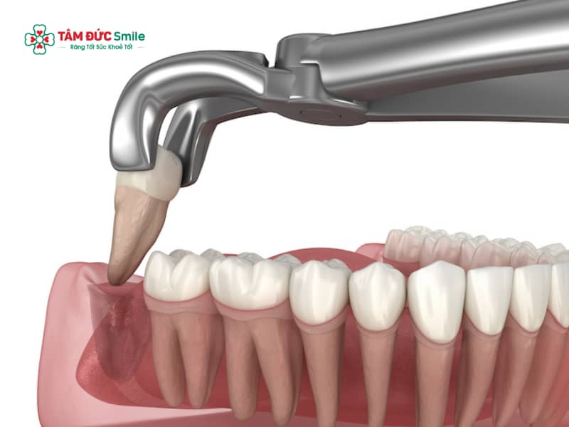 Nhổ răng khôn bao lâu thì súc miệng nước muối? Cách súc miệng nước muối đúng sau nhổ răng khôn