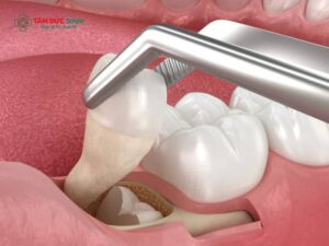 Nhổ răng khôn có ăn được thịt gà không? Những thực phẩm nên và không nên ăn sau khi nhổ răng