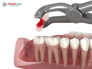 Nhổ răng khôn mất bao lâu? Thời gian nhổ răng khôn và hồi phục