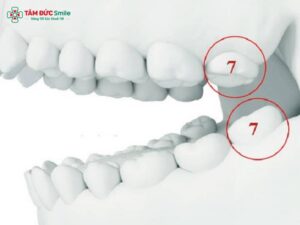 Nhổ răng số 7 có cần trồng lại không? Các phương pháp trồng răng số 7 hiện nay