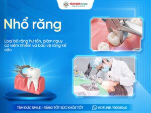 Nhổ răng là gì? Khi nào cần nhổ? Quy trình và Lưu ý cần biết