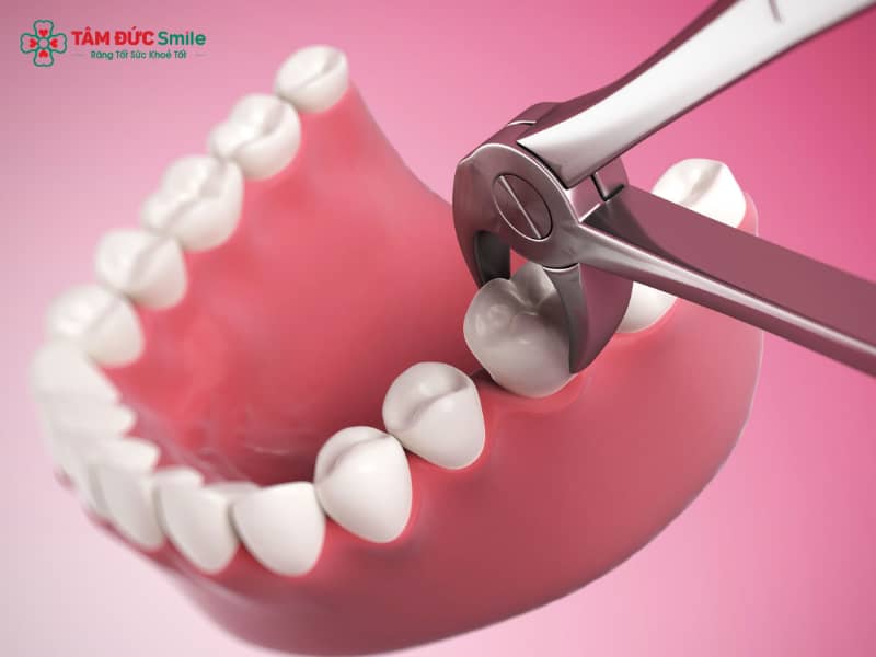 Những biến chứng sau khi nhổ răng số 8: Dấu hiệu cảnh báo, mức độ nguy hiểm và cách xử lý