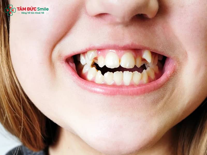 Niềng răng khểnh là gì? Niềng răng khểnh có nên không? Quy trình niềng răng khểnh