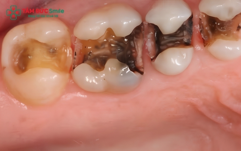 Sâu răng hình thành từ sự kết hợp giữa mảng bám, chế độ ăn nhiều đường và vệ sinh răng miệng chưa đúng cách.