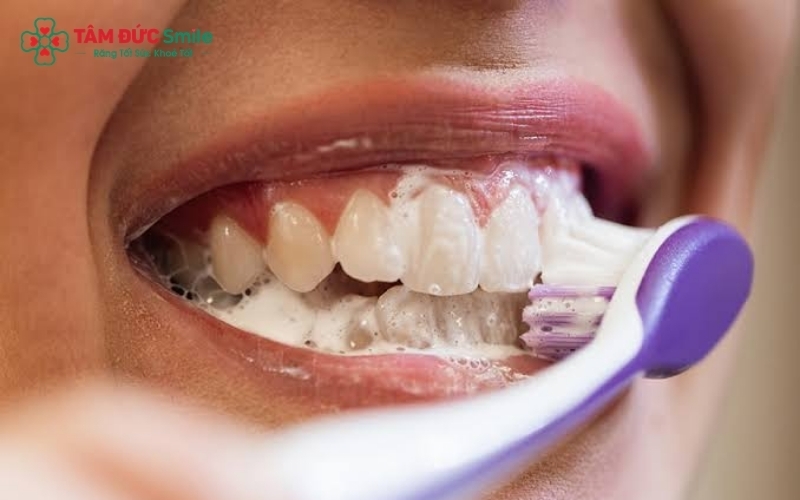 Kết hợp đánh răng đúng kỹ thuật, sử dụng kem Fluor và làm sạch kẽ răng là "chìa khóa" giúp ngăn ngừa sâu răng hiệu quả.