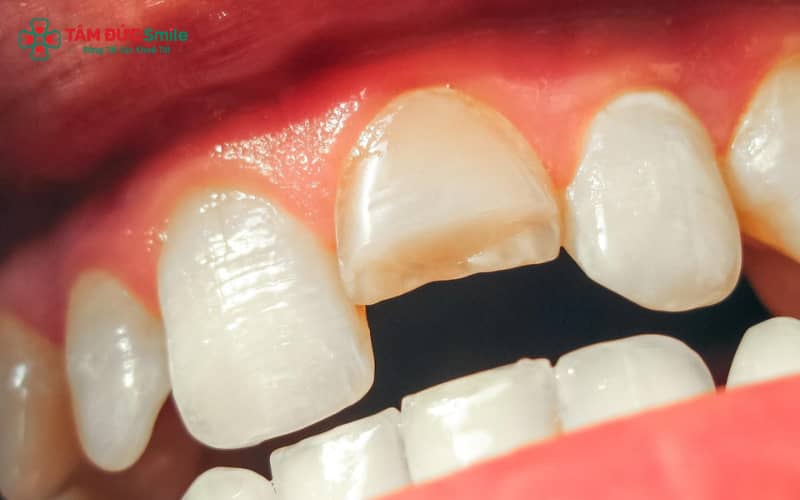 Những nguyên nhân thường gặp khiến răng bị nứt – cần nhận biết sớm để phòng tránh tổn thương nặng hơn