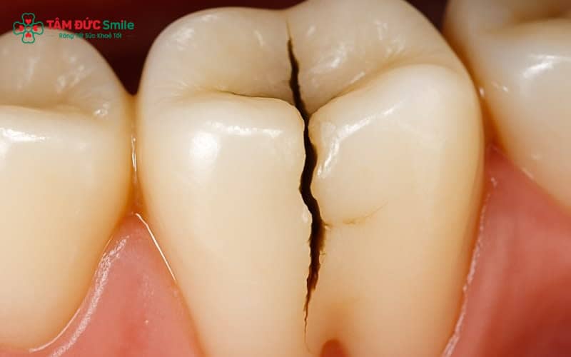 Răng bị nứt có thể gây viêm tủy, áp xe và thậm chí mất răng nếu không điều trị kịp thời