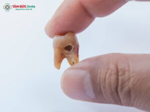 Răng bị sâu lỗ to: Nguy cơ, điều trị sâu răng nặng, viêm tủy, áp xe và cách ngăn ngừa