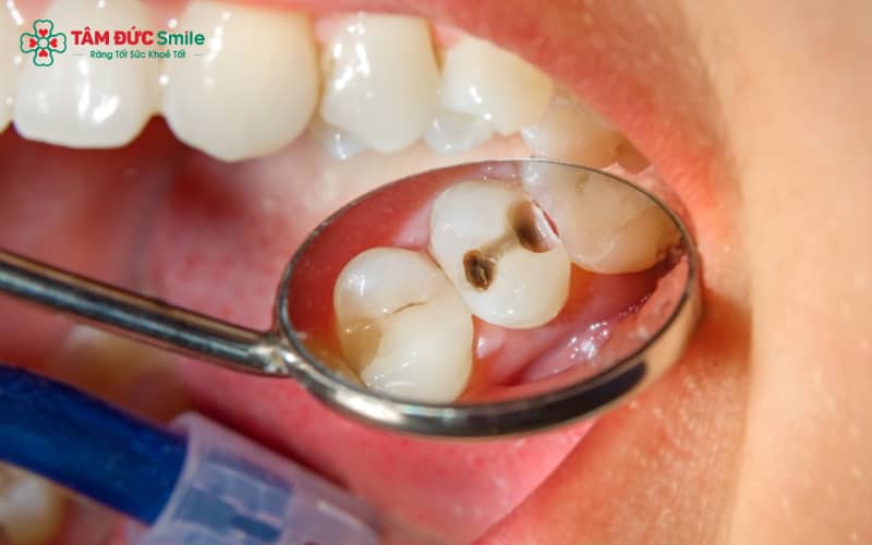 Răng bị sâu lỗ to có trám được không? Giải pháp điều trị răng sâu lỗ lớn hiệu quả
