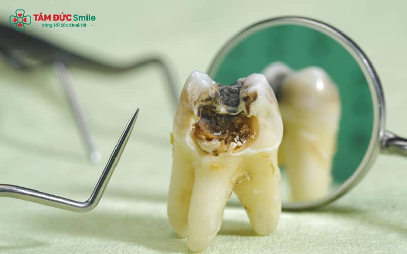 Sâu răng nhẹ đánh răng có hết không? Nguyên nhân, cách trị hiệu quả và phòng ngừa sâu răng
