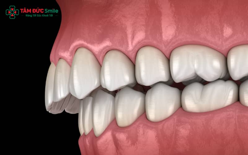 Răng hô có thể do di truyền, thói quen xấu, răng mọc lệch hoặc cấu trúc xương hàm