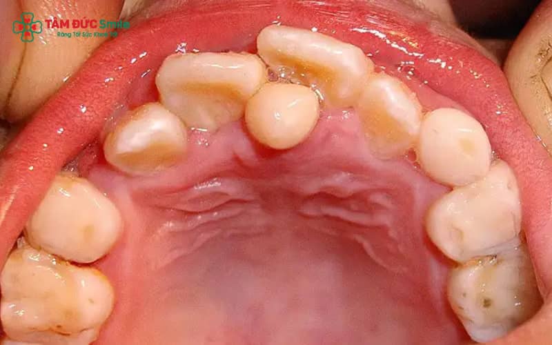 Răng khểnh hàm dưới có thể làm mất cân đối nụ cười, ảnh hưởng đến thẩm mỹ khuôn mặt và gây khó khăn trong ăn nhai nếu lệch nhiều