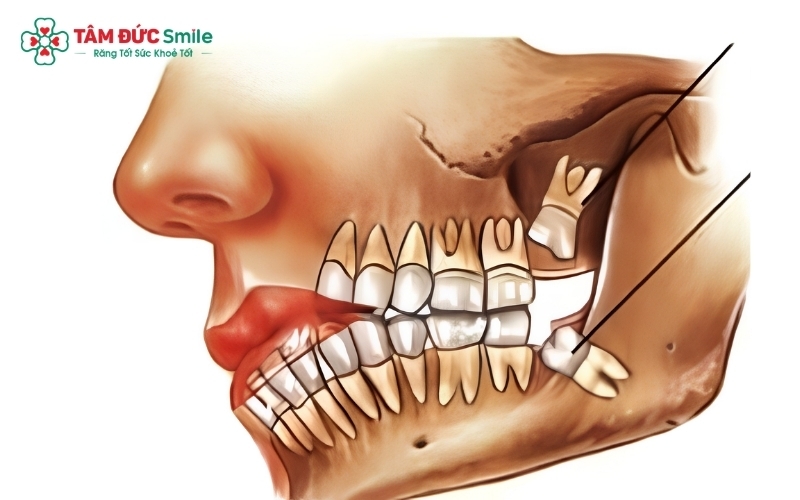 Răng khôn (răng số 8) là chiếc răng hàm lớn thứ ba, nằm ở vị trí trong cùng trên cung hàm.