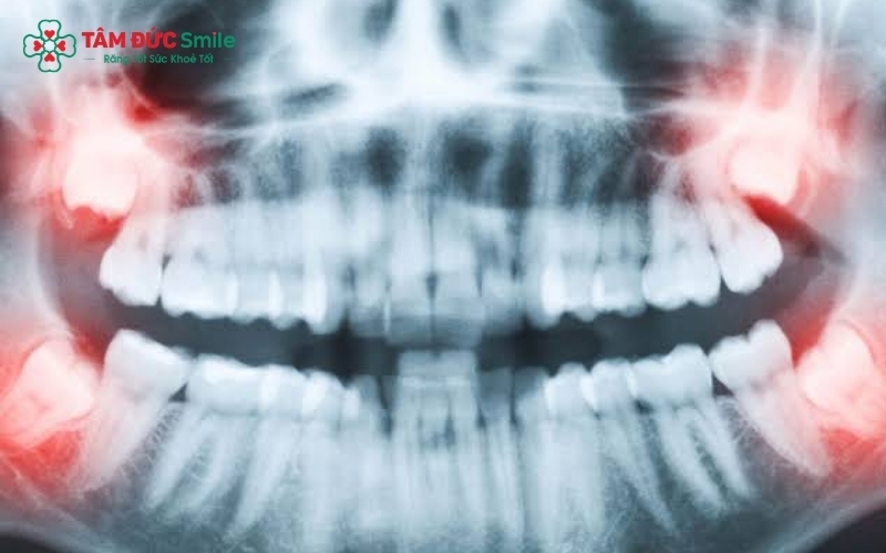  X-quang giúp bác sĩ xác định chính xác số lượng răng khôn và hướng mọc ngầm của chúng trong xương hàm.